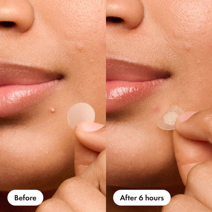 Invisible Acne Patch Overnight Hydrocolloid Pimple Patches for Clear Smooth Skin❤